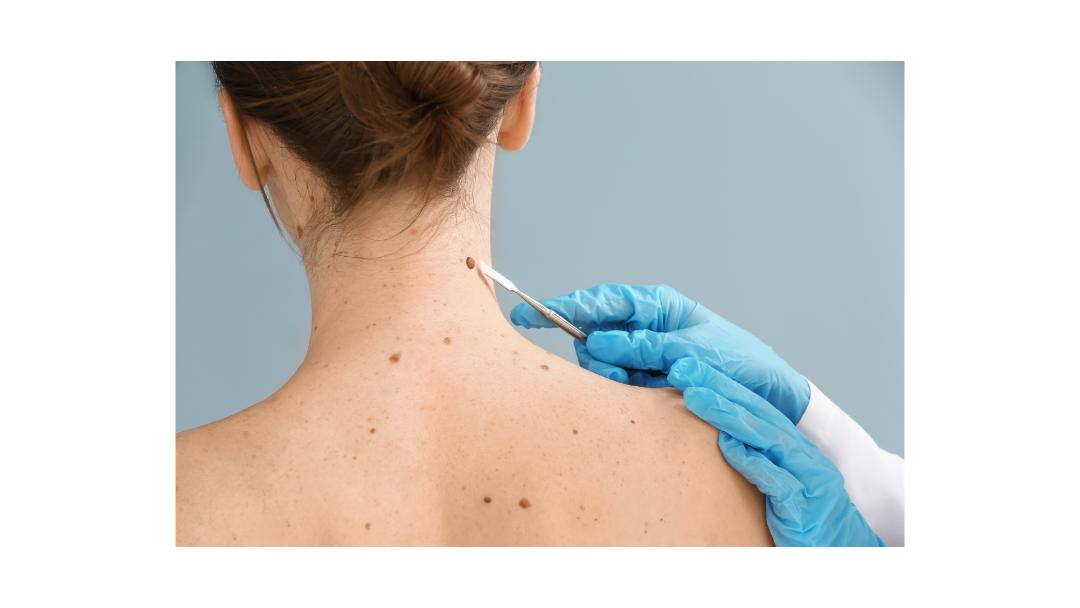 Small lump and skin lesion assessment at Klinik Dr Care Rawang